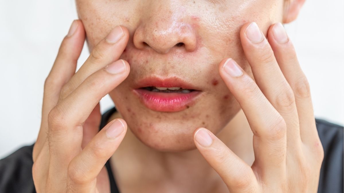 Cẩm Nang Toàn Diện Chăm Sóc Da Dầu Mụn